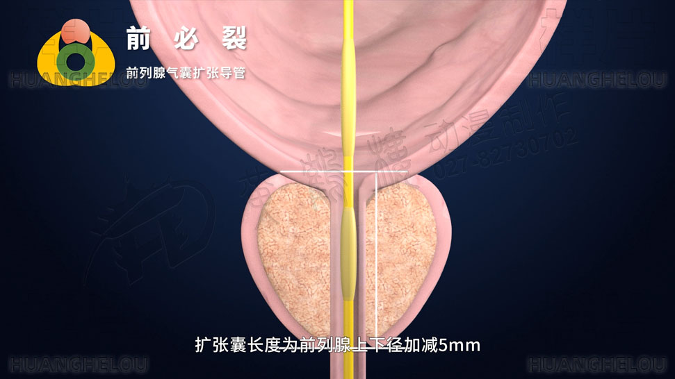 三维3d医学动画制作《经尿道前列腺气囊扩张导管术》手术演示动画片04.jpg