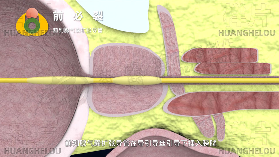 三维3d医学动画制作《经尿道前列腺气囊扩张导管术》手术演示动画片07.jpg