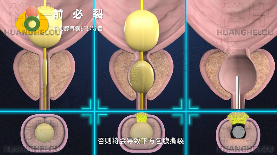 三维3d医学动画制作《经尿道前列腺气囊扩张导管术》手术演示动画片12.jpg
