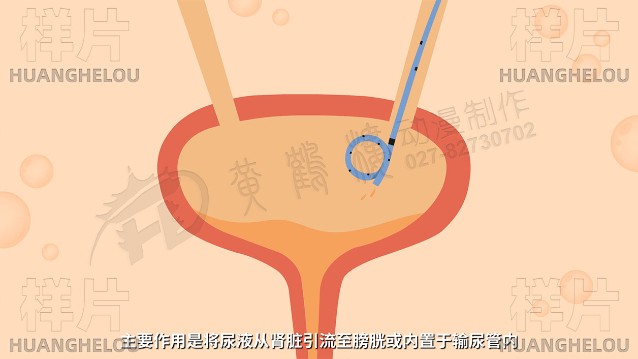 主要作用是将尿液从肾脏引流至膀胱或内置于输尿管内2.jpg